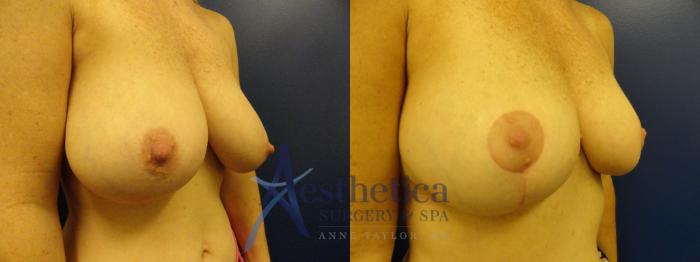 Breast Reduction Case 408 Before & After View #4 | Columbus, OH | Aesthetica Surgery & Spa