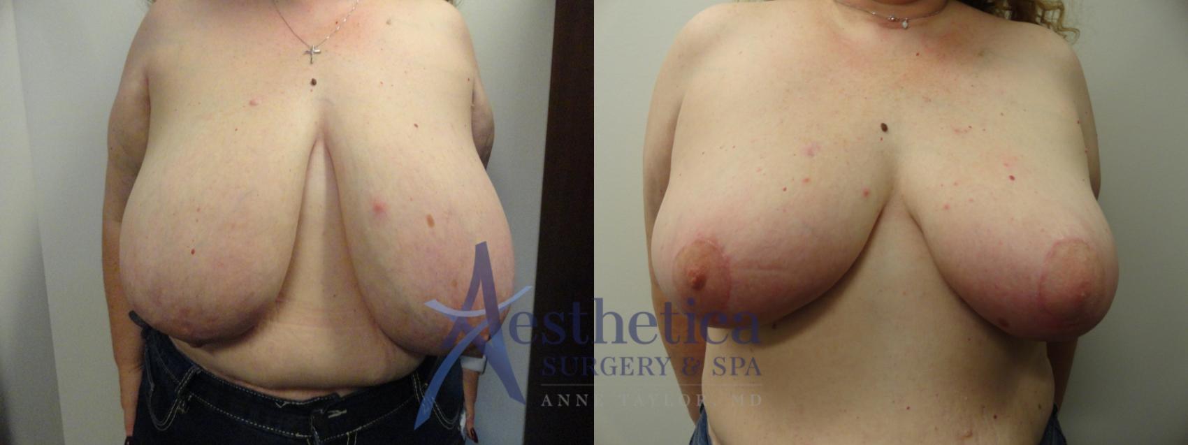 Breast Reduction Case 409 Before & After View #1 | Columbus, OH | Aesthetica Surgery & Spa
