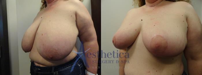 Breast Reduction Case 409 Before & After View #2 | Columbus, OH | Aesthetica Surgery & Spa