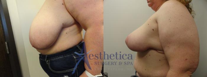 Breast Reduction Case 409 Before & After View #3 | Columbus, OH | Aesthetica Surgery & Spa