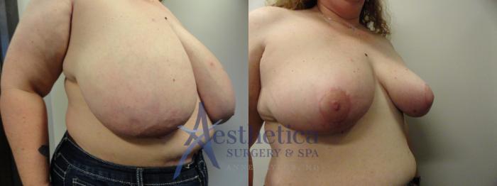 Breast Reduction Case 409 Before & After View #4 | Columbus, OH | Aesthetica Surgery & Spa