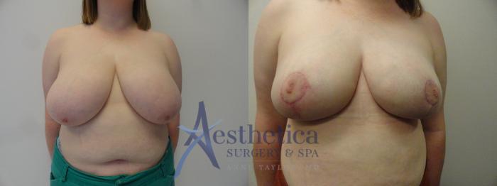 Breast Reduction Case 410 Before & After View #1 | Columbus, OH | Aesthetica Surgery & Spa