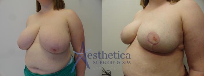 Breast Reduction Case 410 Before & After View #2 | Columbus, OH | Aesthetica Surgery & Spa
