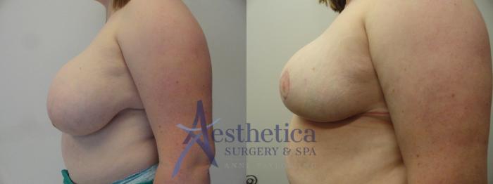 Breast Reduction Case 410 Before & After View #3 | Columbus, OH | Aesthetica Surgery & Spa
