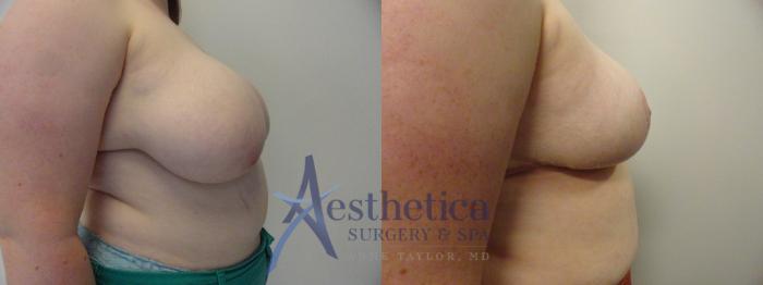 Breast Reduction Case 410 Before & After View #5 | Columbus, OH | Aesthetica Surgery & Spa