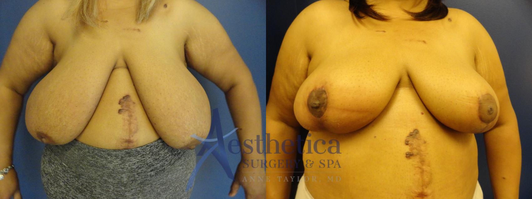 Breast Reduction Case 411 Before & After View #1 | Columbus, OH | Aesthetica Surgery & Spa