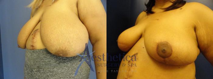 Breast Reduction Case 411 Before & After View #2 | Columbus, OH | Aesthetica Surgery & Spa