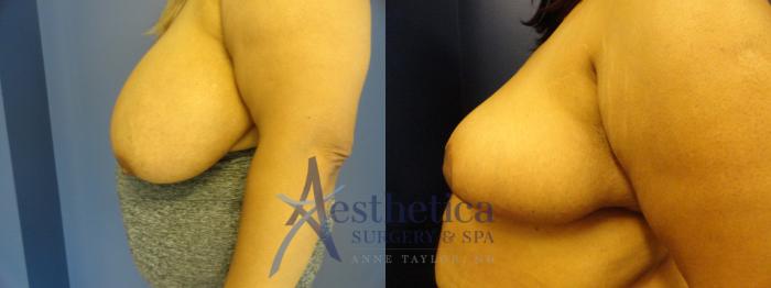 Breast Reduction Case 411 Before & After View #3 | Columbus, OH | Aesthetica Surgery & Spa
