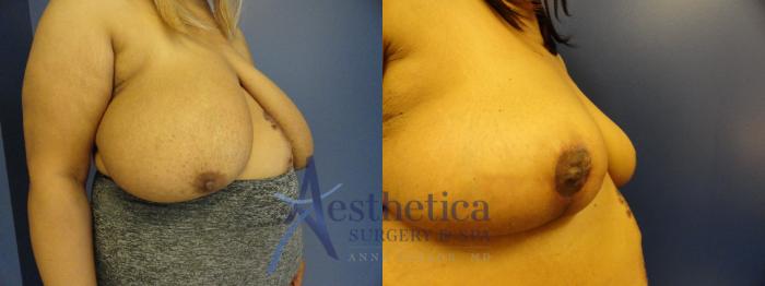 Breast Reduction Case 411 Before & After View #4 | Columbus, OH | Aesthetica Surgery & Spa