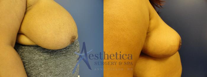 Breast Reduction Case 411 Before & After View #5 | Columbus, OH | Aesthetica Surgery & Spa