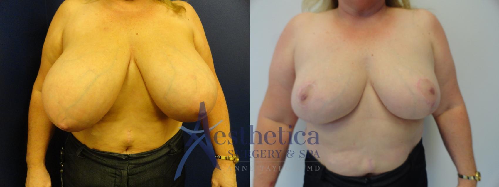 Breast Reduction Case 412 Before & After View #1 | Columbus, OH | Aesthetica Surgery & Spa