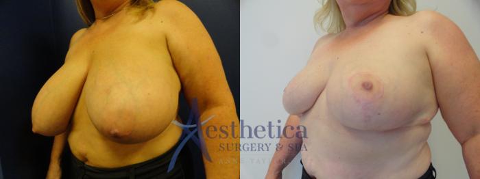 Breast Reduction Case 412 Before & After View #2 | Columbus, OH | Aesthetica Surgery & Spa