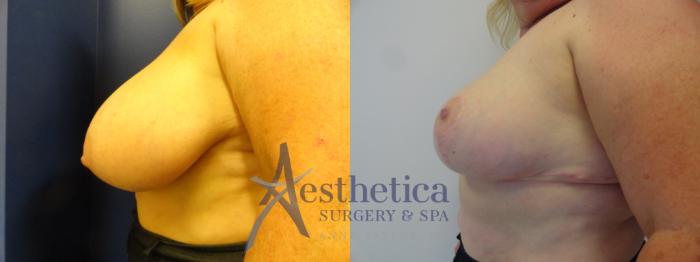 Breast Reduction Case 412 Before & After View #3 | Columbus, OH | Aesthetica Surgery & Spa