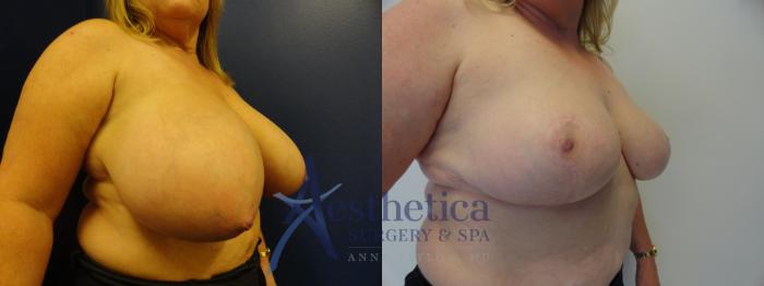 Breast Reduction Case 412 Before & After View #4 | Columbus, OH | Aesthetica Surgery & Spa