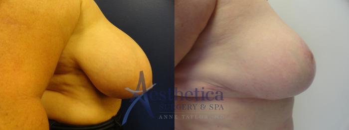 Breast Reduction Case 412 Before & After View #5 | Columbus, OH | Aesthetica Surgery & Spa