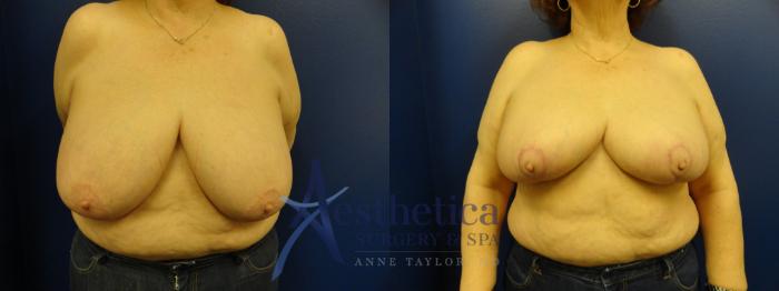 Breast Reduction Case 413 Before & After View #1 | Columbus, OH | Aesthetica Surgery & Spa