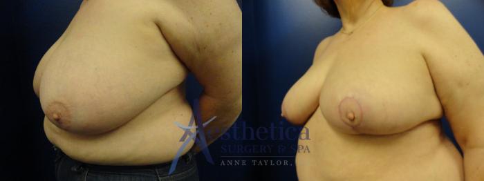 Breast Reduction Case 413 Before & After View #2 | Columbus, OH | Aesthetica Surgery & Spa