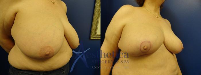 Breast Reduction Case 413 Before & After View #3 | Columbus, OH | Aesthetica Surgery & Spa