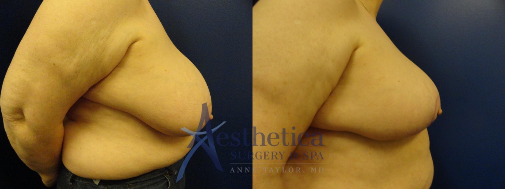 Breast Reduction Case 413 Before & After View #4 | Columbus, OH | Aesthetica Surgery & Spa