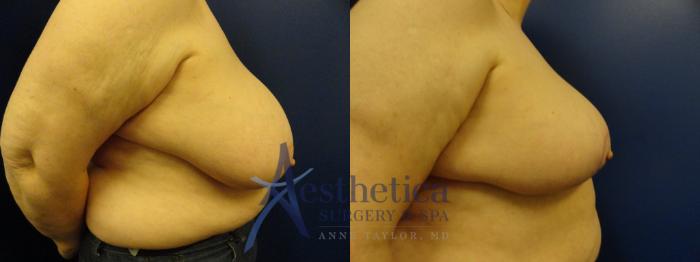 Breast Reduction Case 413 Before & After View #4 | Columbus, OH | Aesthetica Surgery & Spa