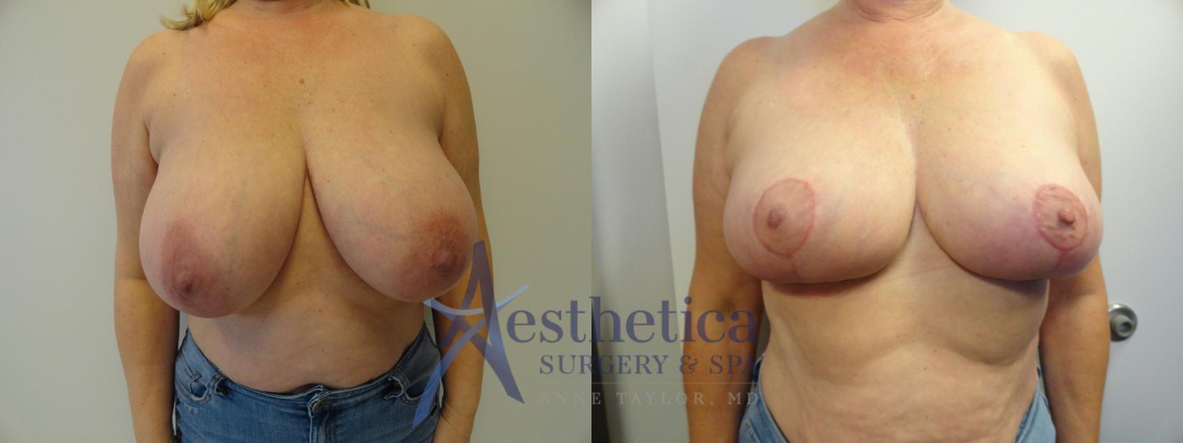 Breast Reduction Case 414 Before & After View #1 | Columbus, OH | Aesthetica Surgery & Spa