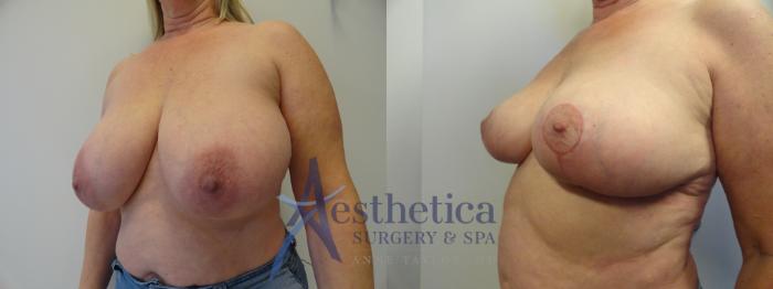 Breast Reduction Case 414 Before & After View #2 | Columbus, OH | Aesthetica Surgery & Spa