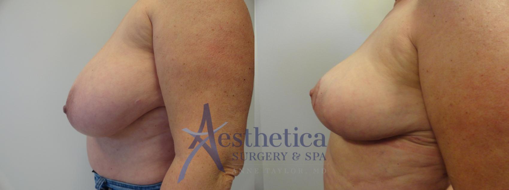 Breast Reduction Case 414 Before & After View #3 | Columbus, OH | Aesthetica Surgery & Spa