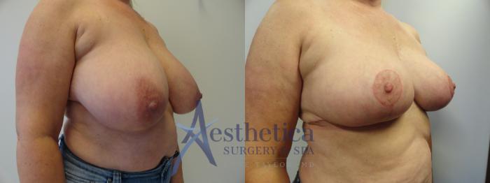 Breast Reduction Case 414 Before & After View #4 | Columbus, OH | Aesthetica Surgery & Spa