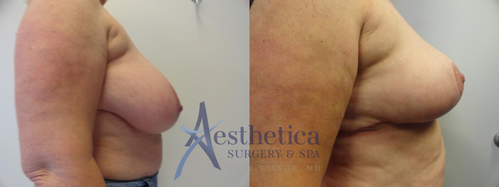 Breast Reduction Case 414 Before & After View #5 | Columbus, OH | Aesthetica Surgery & Spa