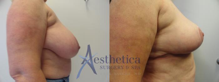 Breast Reduction Case 414 Before & After View #5 | Columbus, OH | Aesthetica Surgery & Spa