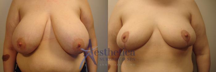 Breast Reduction Case 419 Before & After View #1 | Columbus, OH | Aesthetica Surgery & Spa