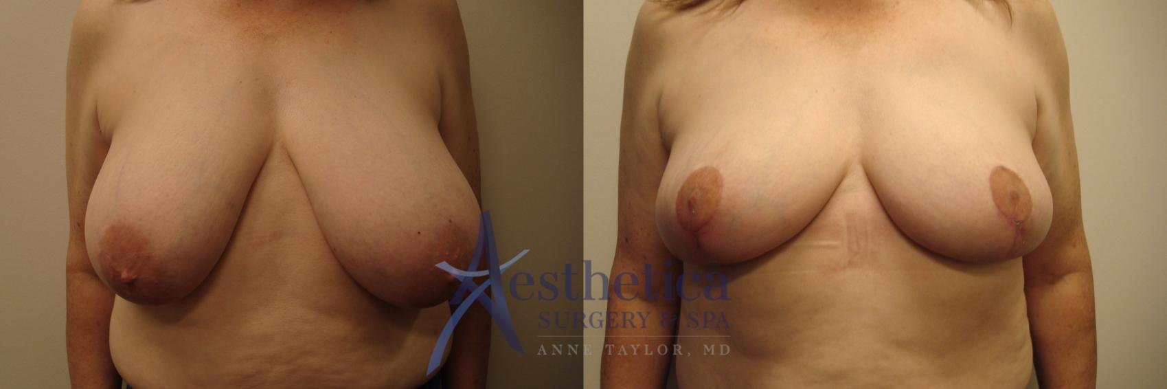 Breast Reduction Case 420 Before & After View #1 | Columbus, OH | Aesthetica Surgery & Spa