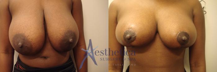 Breast Reduction Case 428 Before & After View #1 | Columbus, OH | Aesthetica Surgery & Spa