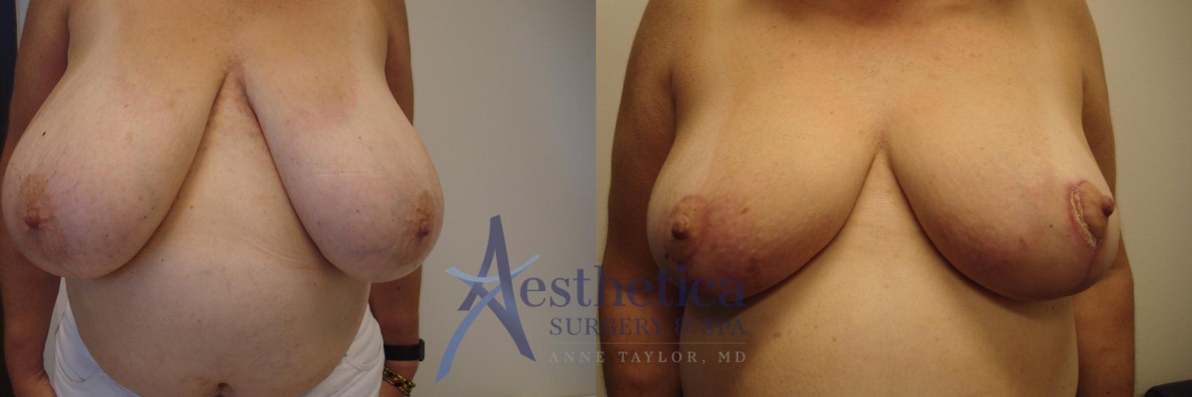 Breast Reduction Case 430 Before & After View #1 | Columbus, OH | Aesthetica Surgery & Spa