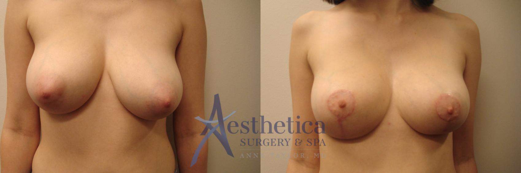 Breast Reduction Case 431 Before & After View #1 | Columbus, OH | Aesthetica Surgery & Spa