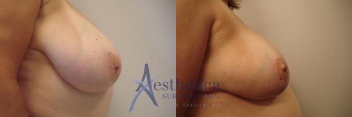 Breast Reduction Case 441 Before & After Right Side | Columbus, OH | Aesthetica Surgery & Spa