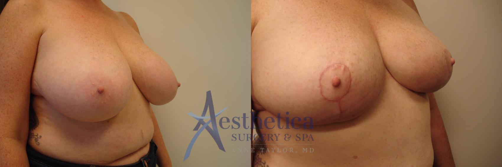 Breast Reduction Case 455 Before & After Right Oblique | Columbus, OH | Aesthetica Surgery & Spa