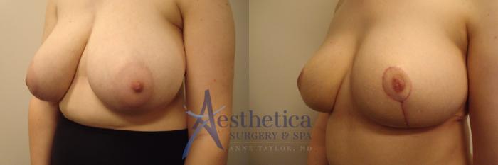Breast Reduction Case 459 Before & After Left Oblique | Columbus, OH | Aesthetica Surgery & Spa
