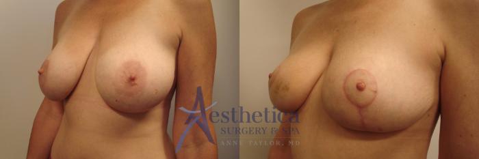 Breast Reduction Case 461 Before & After Left Oblique | Columbus, OH | Aesthetica Surgery & Spa