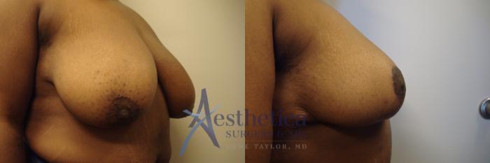 Breast Reduction Case 483 Before & After Right Side | Columbus, OH | Aesthetica Surgery & Spa