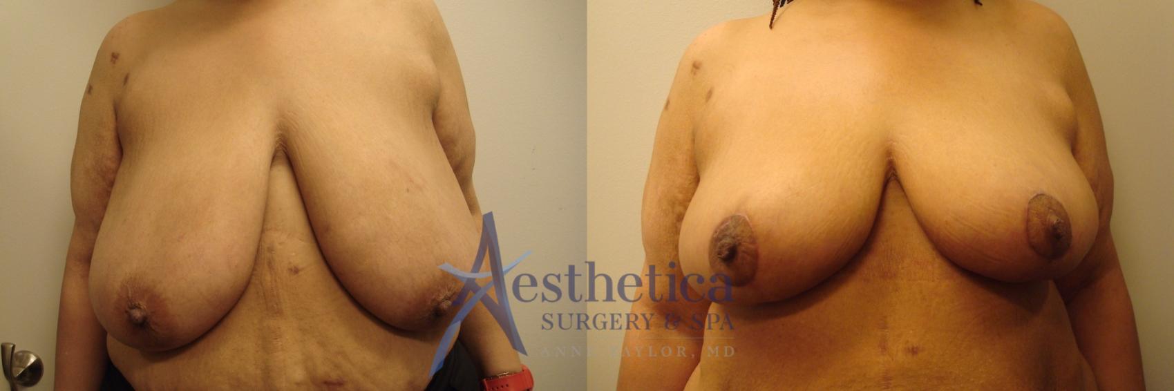 Breast Reduction Case 486 Before & After Front | Worthington, OH | Aesthetica Surgery & Spa