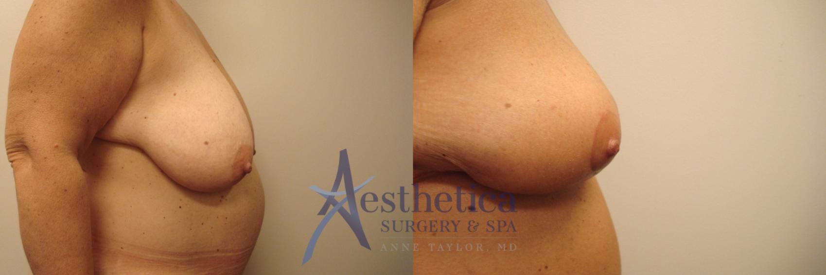 Breast Reduction Case 498 Before & After Right Side | Columbus, OH | Aesthetica Surgery & Spa
