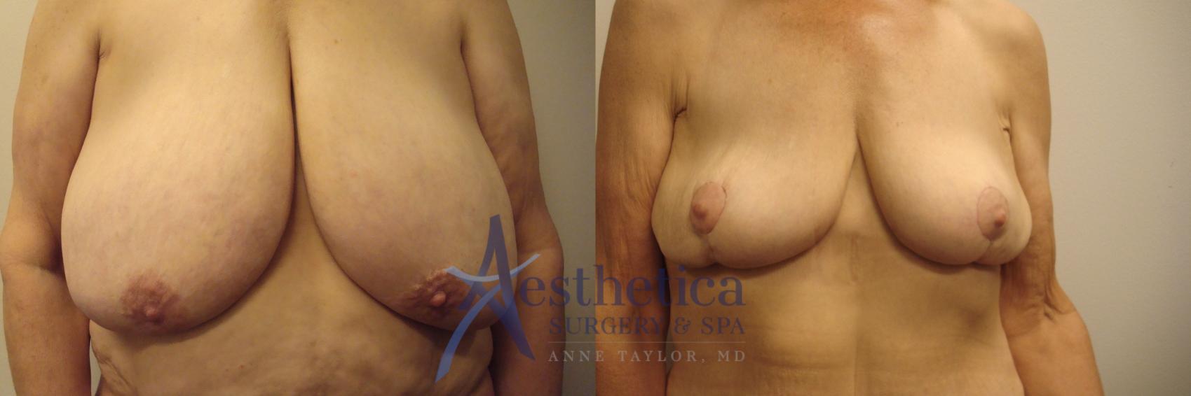 Breast Reduction Case 519 Before & After Front | Columbus, OH | Aesthetica Surgery & Spa