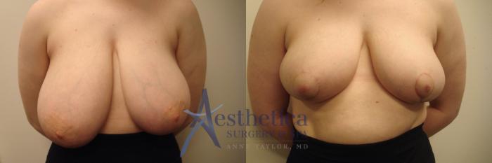 Breast Reduction Case 570 Before & After Front | Columbus, OH | Aesthetica Surgery & Spa