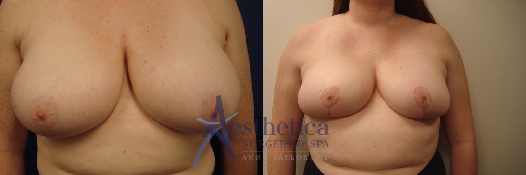 Breast Reduction Case 578 Before & After Front | Columbus, OH | Aesthetica Surgery & Spa