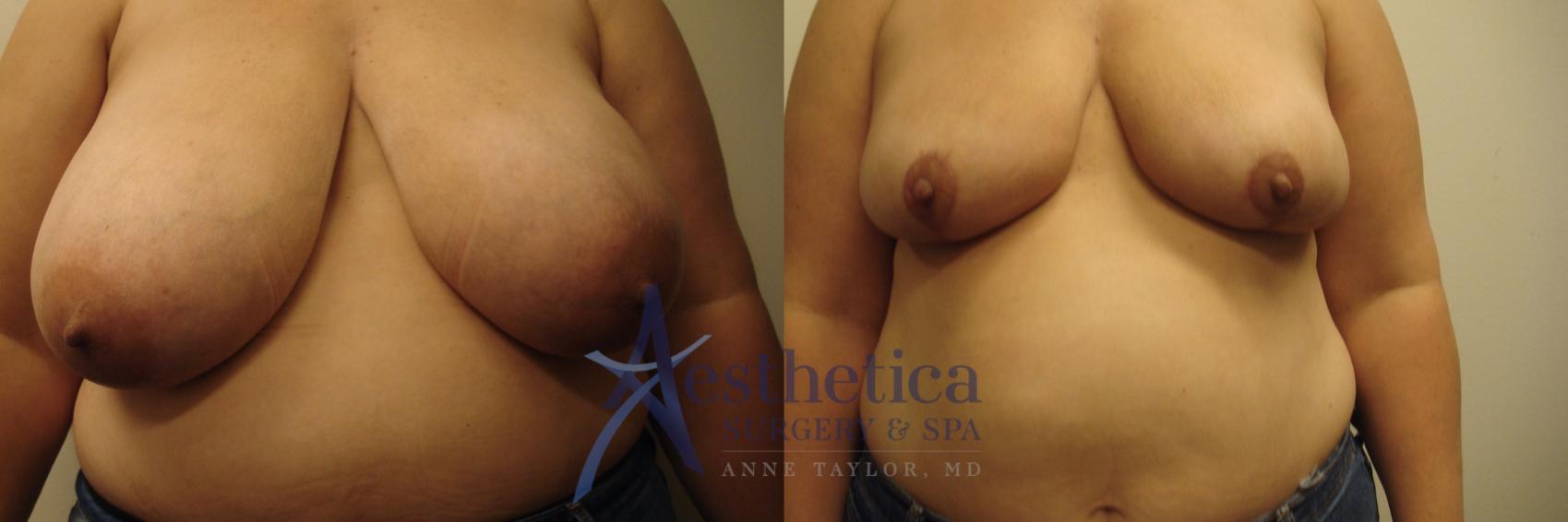 Breast Reduction Case 583 Before & After Front | Columbus, OH | Aesthetica Surgery & Spa
