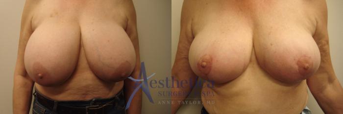 Breast Reduction Case 602 Before & After Front | Columbus, OH | Aesthetica Surgery & Spa