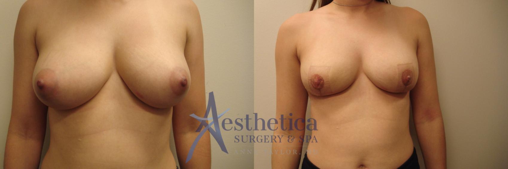 Breast Reduction Case 671 Before & After Front | Columbus, OH | Aesthetica Surgery & Spa
