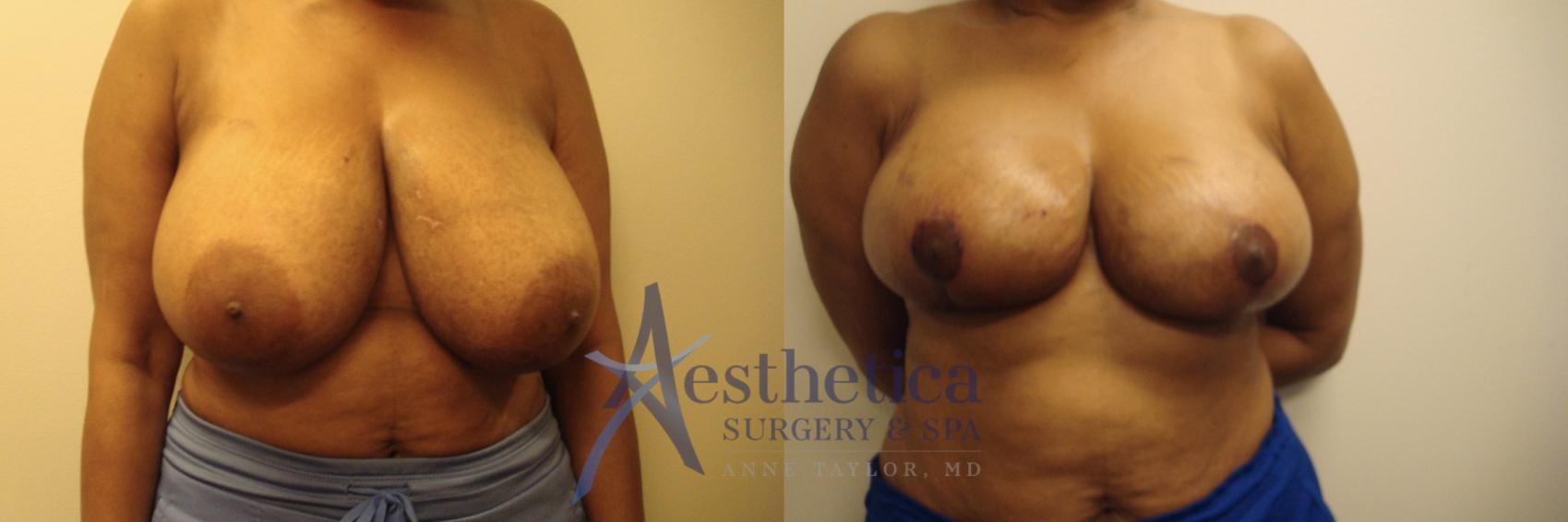 Breast Reduction Case 680 Before & After Front | Columbus, OH | Aesthetica Surgery & Spa