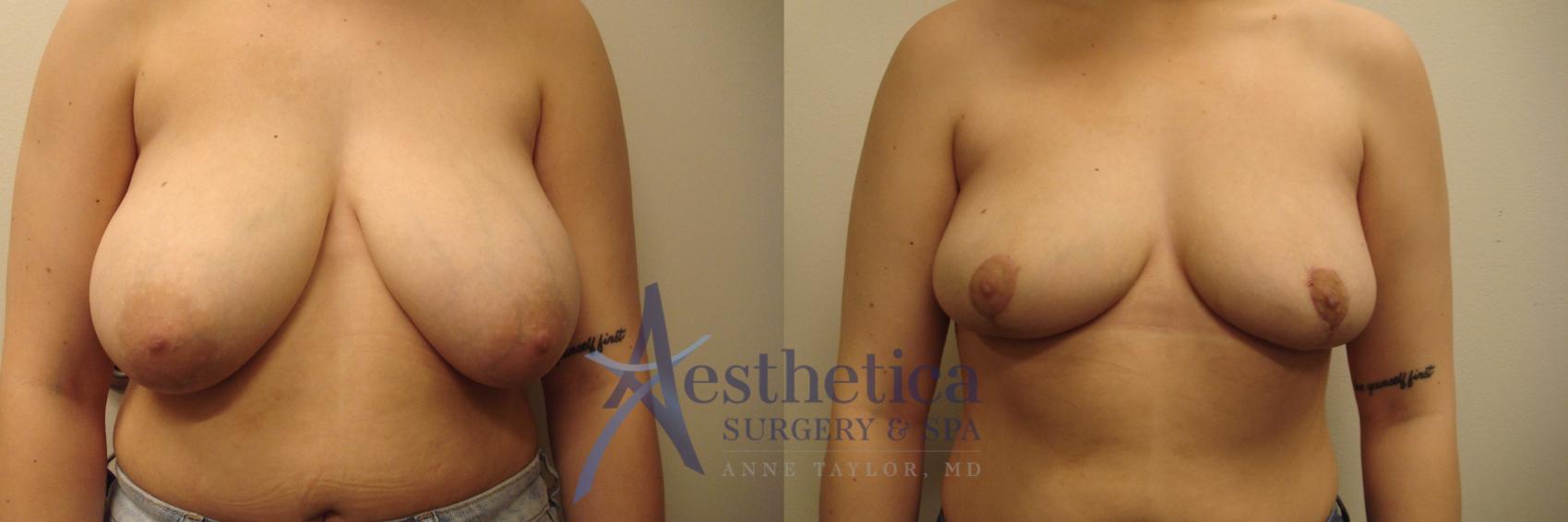 Breast Reduction Case 686 Before & After Front | Columbus, OH | Aesthetica Surgery & Spa